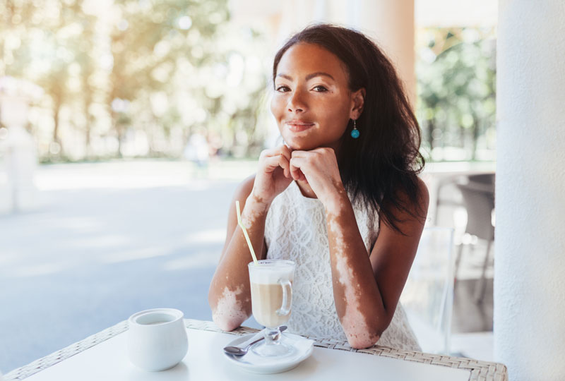 African American woman with vitiligo on face and forearms sits at a cafe table.